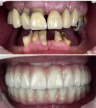 Результат до та після імплантації All-on-4 у Rosental Dental – відновлення посмішки