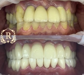 Before and after All-on-4 dental implants result at Rosental Dental – full smile restoration