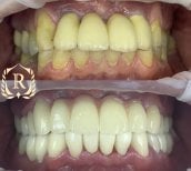 Before and after All-on-4 dental implants result at Rosental Dental – full smile restoration