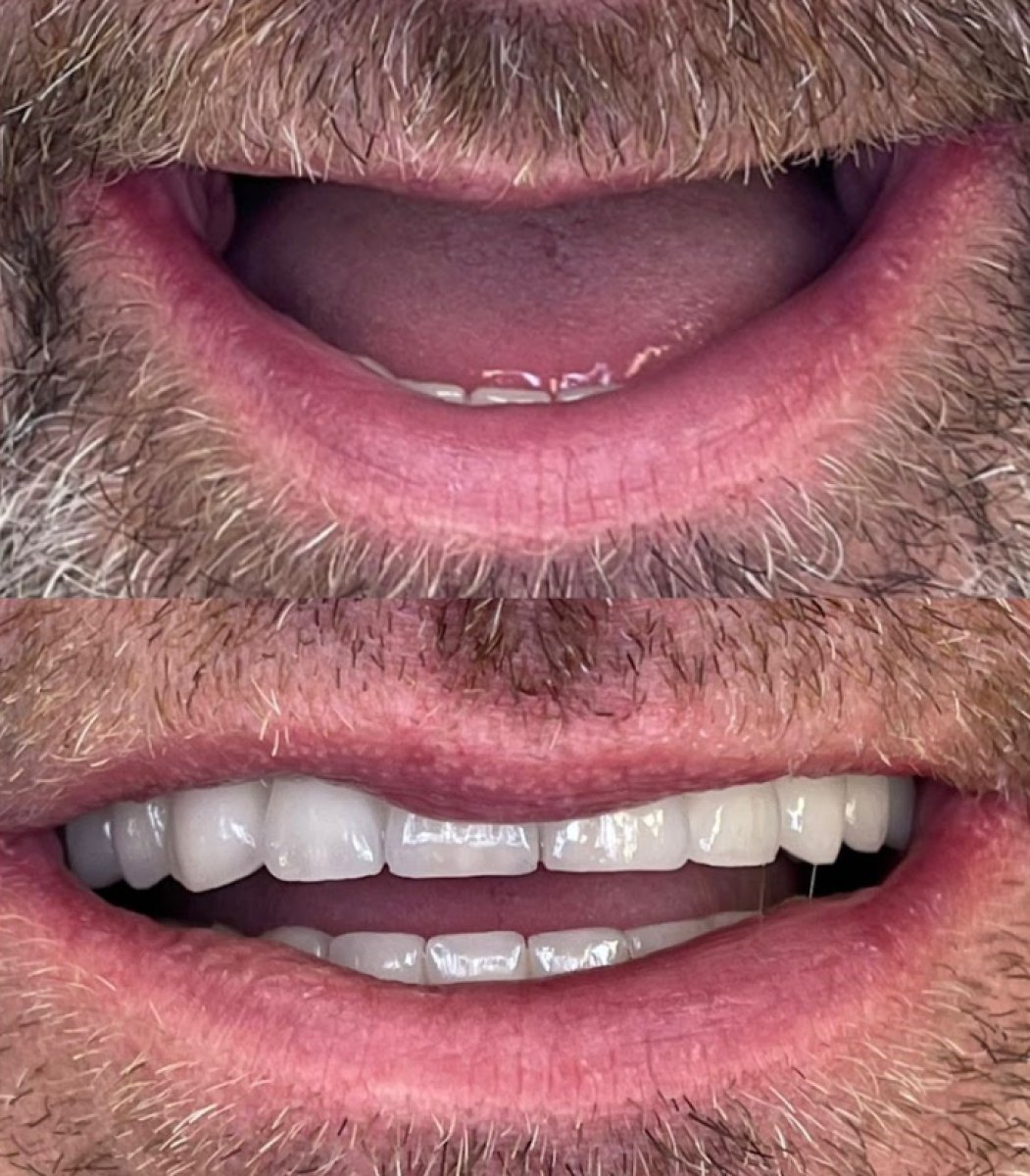 نتيجة قبل وبعد زراعة الأسنان All-on-4 في Rosental Dental – استعادة الابتسامة الكاملة