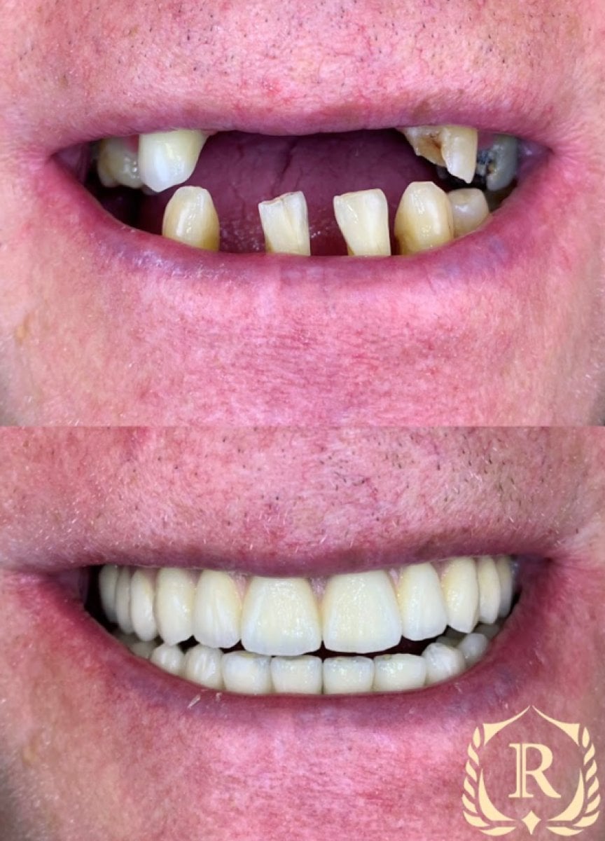 Antes y después de implantes dentales All-on-4 en Rosental Dental – restauración total de sonrisa