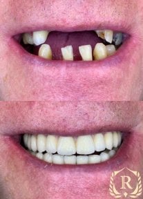 Before and after All-on-4 dental implants result at Rosental Dental – full smile restoration