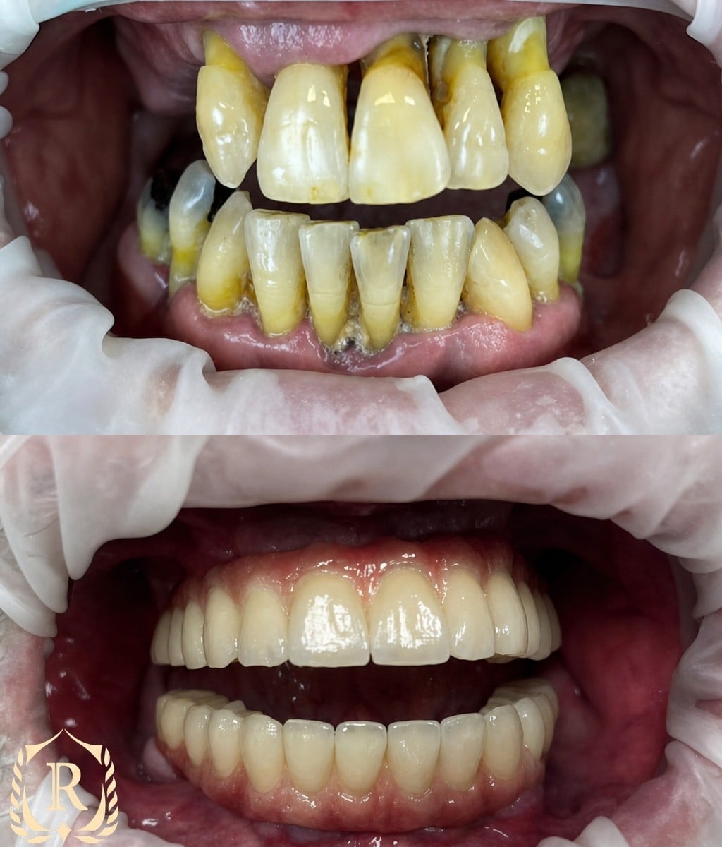 Antes y después de implantes dentales All-on-4 en Rosental Dental – restauración total de sonrisa
