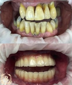 До та після імплантації All-on-4 у Rosental Dental – відновлення посмішки