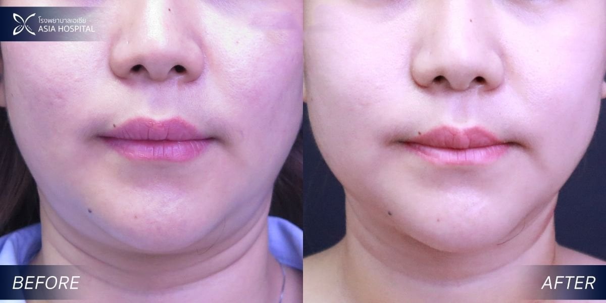 نتيجة شفط دهون الذقن المزدوج قبل وبعد في Asia Cosmetic Hospital، تحديد الفك المحسن