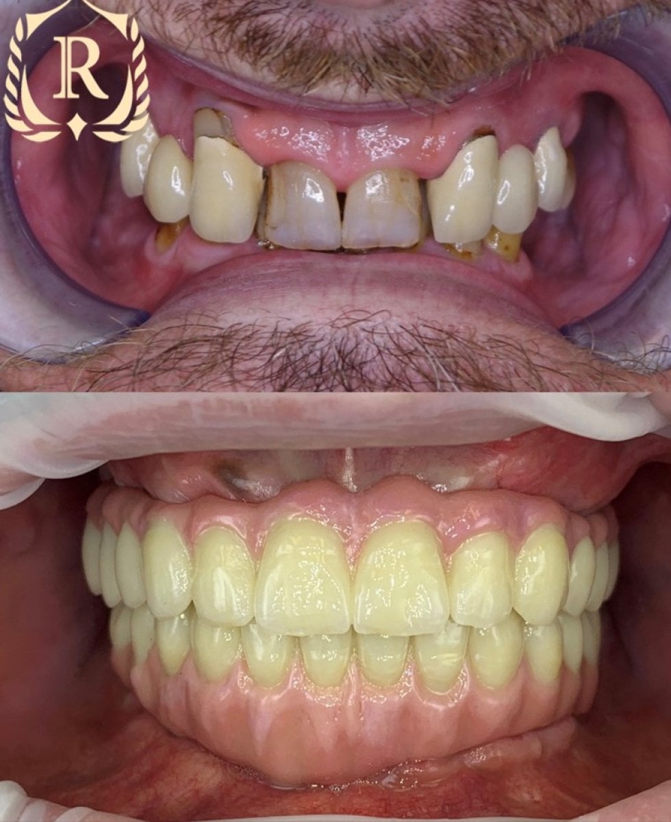 نتيجة قبل وبعد زراعة الأسنان All-on-4 في Rosental Dental – استعادة الابتسامة الكاملة