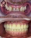 Результат до и после имплантации All-on-4 в Rosental Dental – полное восстановление улыбки