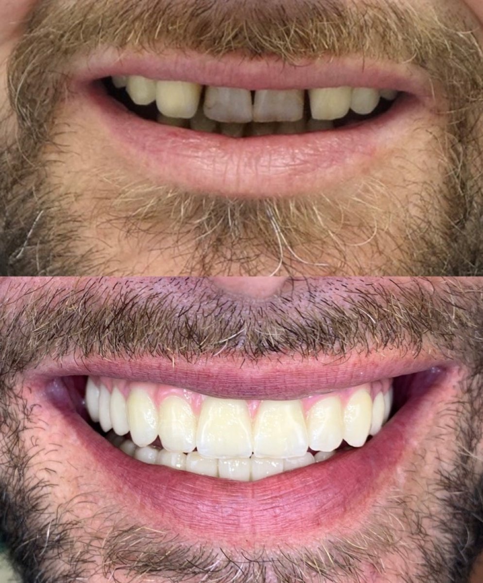 Résultat avant/après implants All-on-4 chez Rosental Dental – sourire amélioré