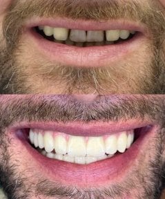 Before and after All-on-4 dental implants result at Rosental Dental – improved smile aesthetics