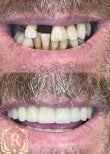 Before and after All-on-4 dental implants result at Rosental Dental – restored smile