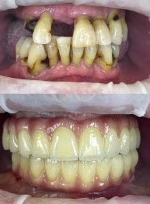 Before and after All-on-4 dental implants result at Rosental Dental – full smile restoration