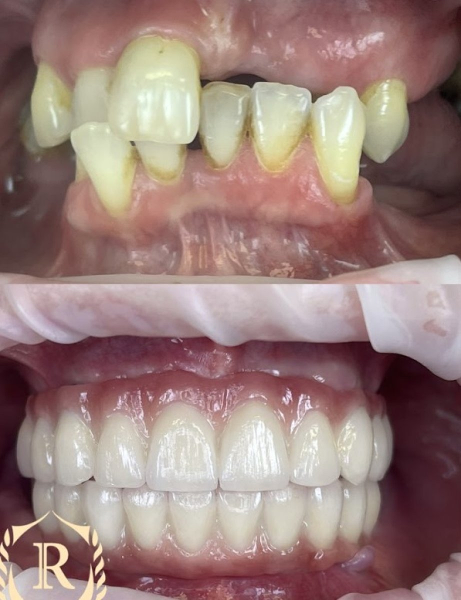 Résultat avant/après implants All-on-4 chez Rosental Dental – restauration complète du sourire