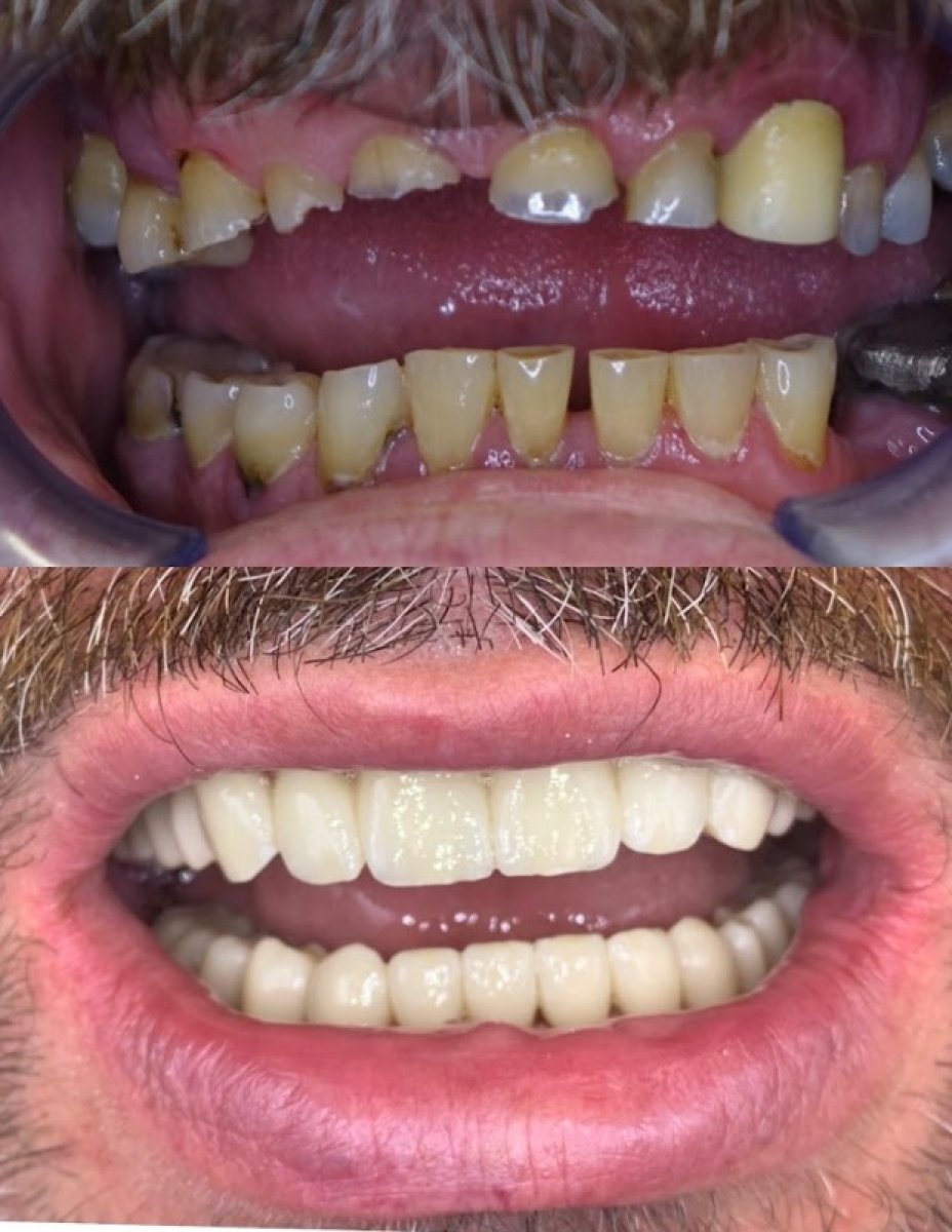 До і після Hollywood Smile у Rosental Dental – повне перетворення посмішки вінірами