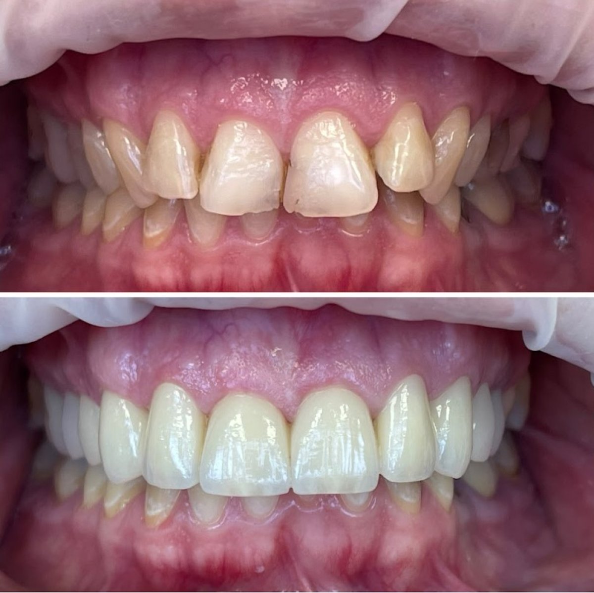 Resultados antes y después de carillas dentales en Rosental Dental