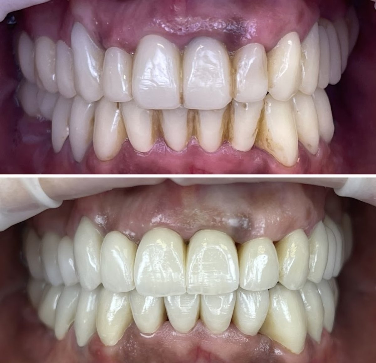 Resultados antes y después de smile makeover en Rosental Dental: mejor color y alineación dental