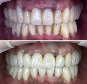 Vorher-nachher-Ergebnis Smile Makeover bei Rosental Dental – bessere Zahnfarbe und Ausrichtung
