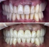 Vorher-nachher-Ergebnis Smile Makeover bei Rosental Dental – bessere Zahnfarbe und Ausrichtung
