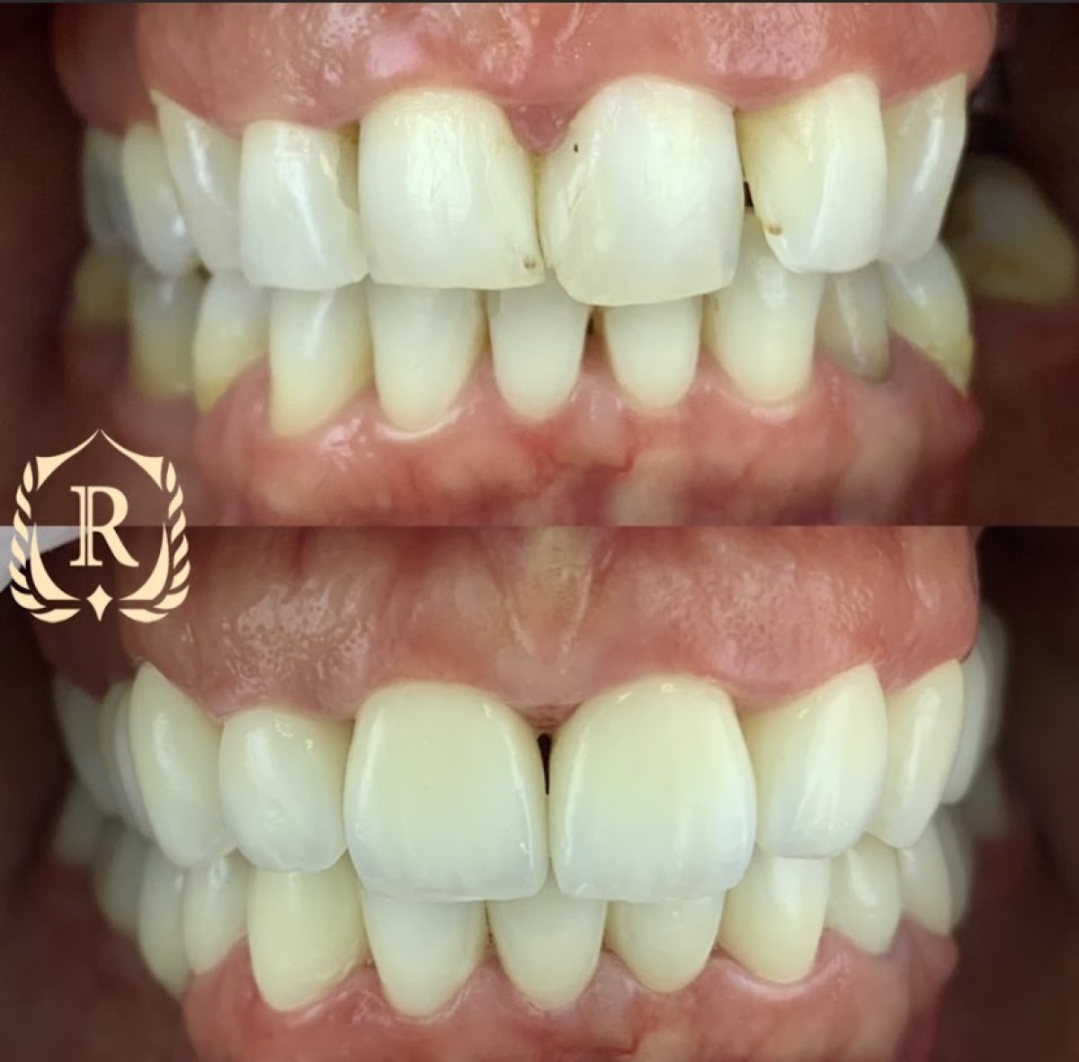 Antes y después de smile makeover en Rosental Dental: mejor alineación y color dental