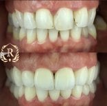 Vorher-nachher-Ergebnis Smile Makeover bei Rosental Dental – bessere Zahnfarbe und Ausrichtung