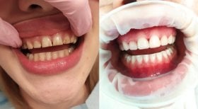 Before and after dental bonding results at Smile Dentica Clinic – improved tooth appearance