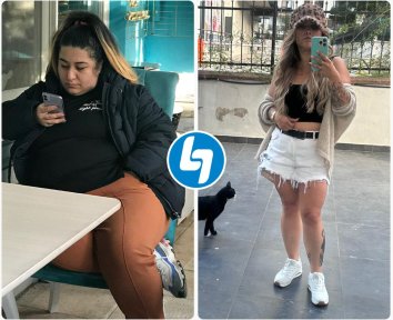 Vorher-nachher-Ergebnisse der Magenresektion im Lokman Hekim Istanbul Hospital, sichtbarer Gewichtsverlust