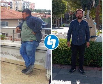 Vorher-nachher-Ergebnis der Magenresektion in Lokman Hekim Istanbul Hospital, sichtbarer Gewichtsverlust
