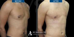 Vorher-nachher-Ergebnisse der Gynäkomastie-OP in der Dr. Safa Manav Klinik, Brustkorrektur
