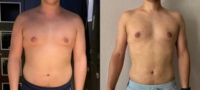 Vorher-nachher-Ergebnisse der Gynäkomastie-OP in der Dr. Safa Manav Klinik, verbesserte Brust