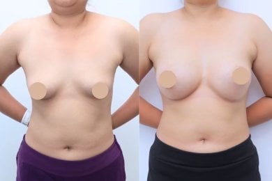 Resultados antes y después de aumento de senos en Wansiri Hospital, forma mejorada