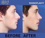 Результаты ринопластики до и после в ID Clinic Bangkok, улучшенная форма носа и профиль