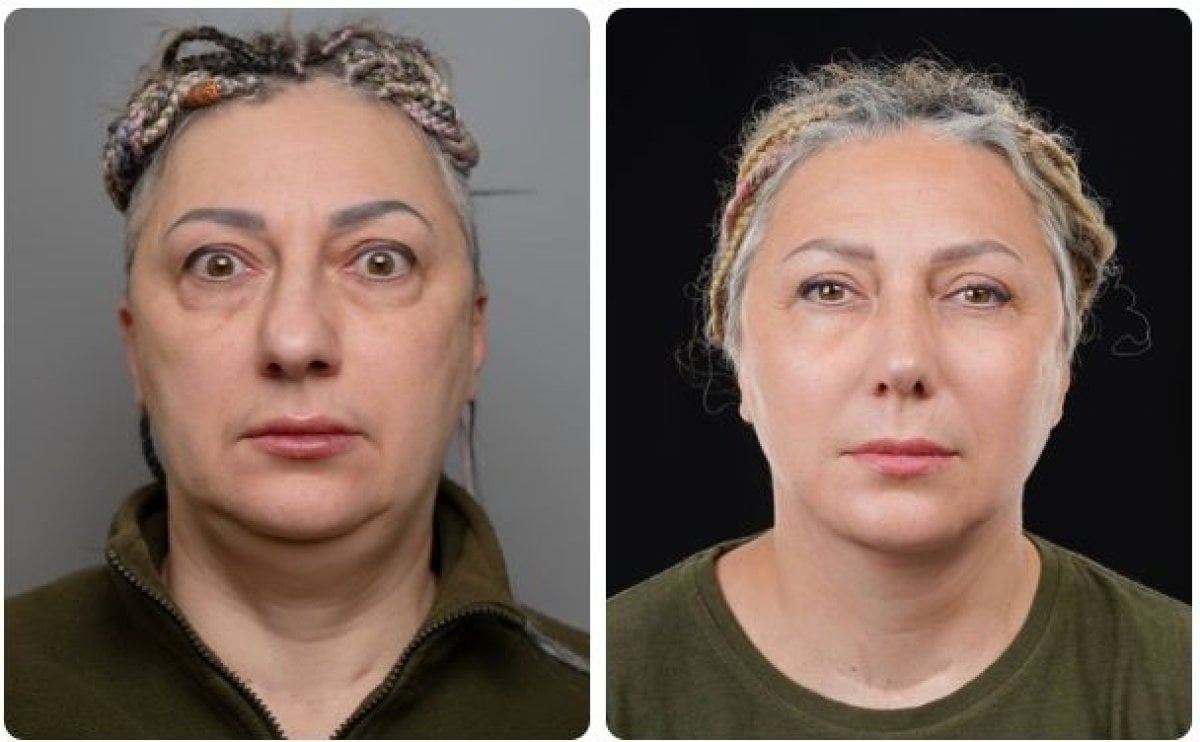Resultados de lifting facial antes y después en Yurchenko Plastic Surgery Team Kyiv, rejuvenecimiento