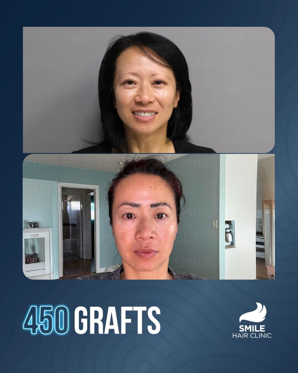 Before and after eyebrow transplant results at Smile Hair Clinic Turkey, 450 grafts used