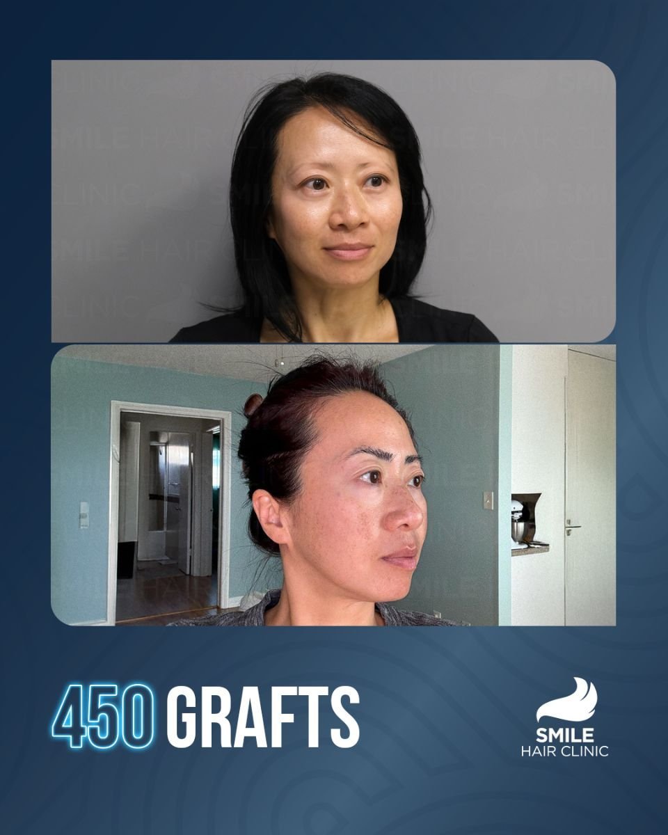 Before and after eyebrow transplant result with 450 grafts at Smile Hair Clinic Turkey