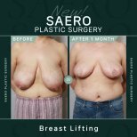 Vorher-nachher-Ergebnis Bruststraffung bei SAERO Plastic Surgery, sichtbare Konturverbesserung