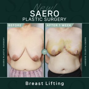 Vorher-nachher-Ergebnis Bruststraffung bei SAERO Plastic Surgery – sichtbare Straffung nach 1 Woche
