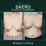 Vorher-nachher-Ergebnis Bruststraffung bei SAERO Plastic Surgery – sichtbare Straffung nach 1 Woche