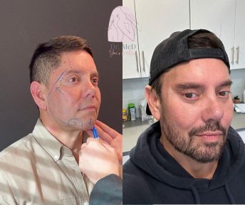 Before and after beard transplant results at Dr. MED, fuller facial hair restoration