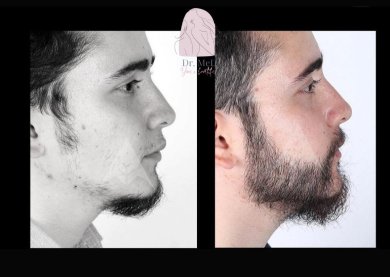 Before and after beard transplant results at Dr. MED – fuller facial hair restoration