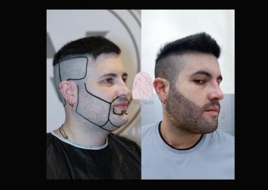 Before and after beard transplant results at Dr. MED – fuller, defined beard appearance