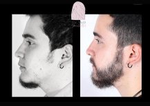 Before and after beard transplant results at Dr. MED – fuller, natural-looking facial hair