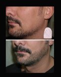 Before and after beard transplant results at Dr. MED – fuller, natural-looking facial hair