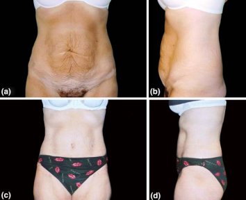 Vorher-nachher-Liposuktionsergebnis in der Cairo Plastic Clinic, sichtbare Bauchkontur