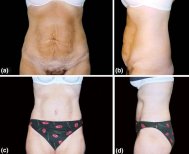 Vorher-nachher-Liposuktionsergebnis in der Cairo Plastic Clinic, sichtbare Bauchkontur