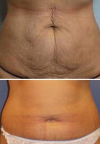 Vorher-nachher-Liposuktionsergebnis bei Cairo Plastic Clinic, verbesserte Bauchkontur