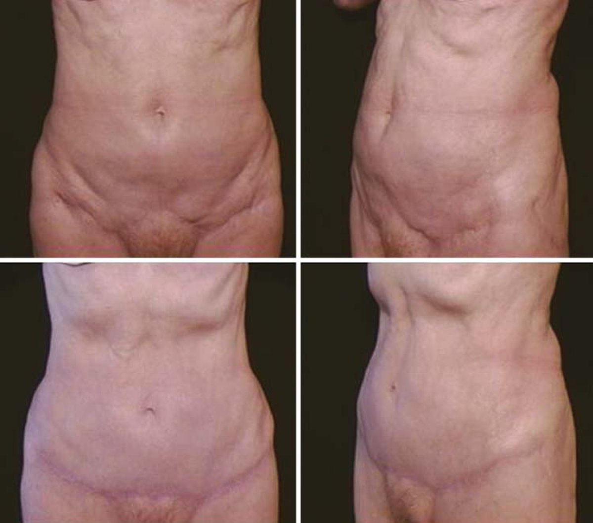 Resultados de liposucción antes y después en Cairo Plastic Clinic, contorno abdominal mejorado