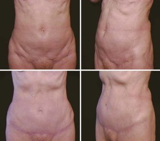 Vorher-nachher-Liposuktionsergebnis bei Cairo Plastic Clinic, verbesserte Bauchkontur