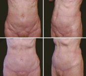 Vorher-nachher-Liposuktionsergebnis bei Cairo Plastic Clinic, verbesserte Bauchkontur