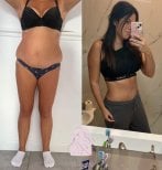 Before and after liposculpture results at Dr. MED – visible waist and abdomen contouring