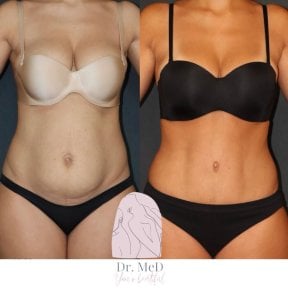 Before and after liposculpture results at Dr. MED, visible waist and abdomen contouring