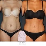 Before and after liposculpture results at Dr. MED, visible waist and abdomen contouring